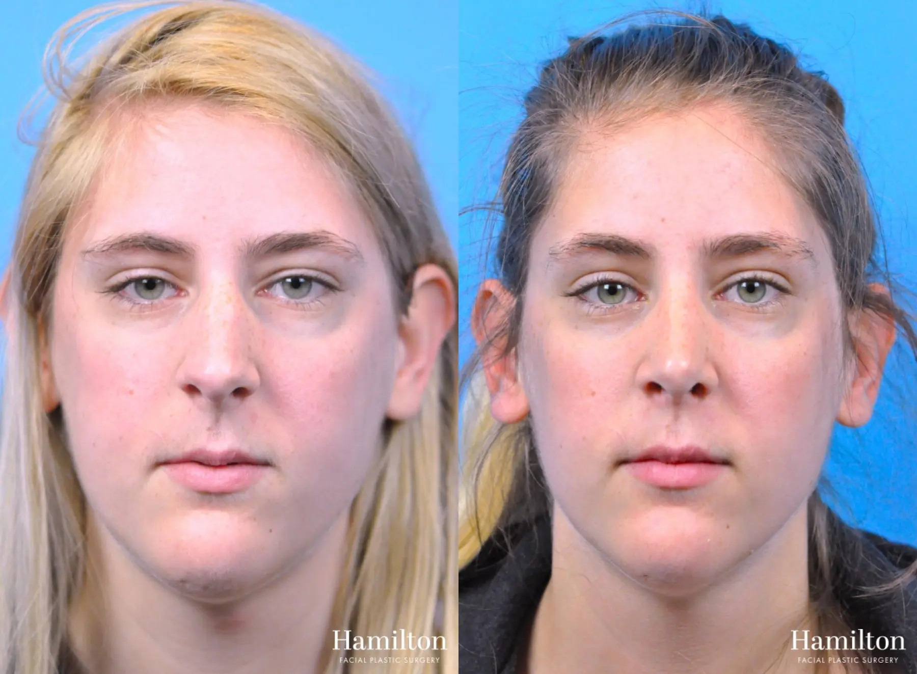 Rhinoplasty: Patient 48 - Before and After 5