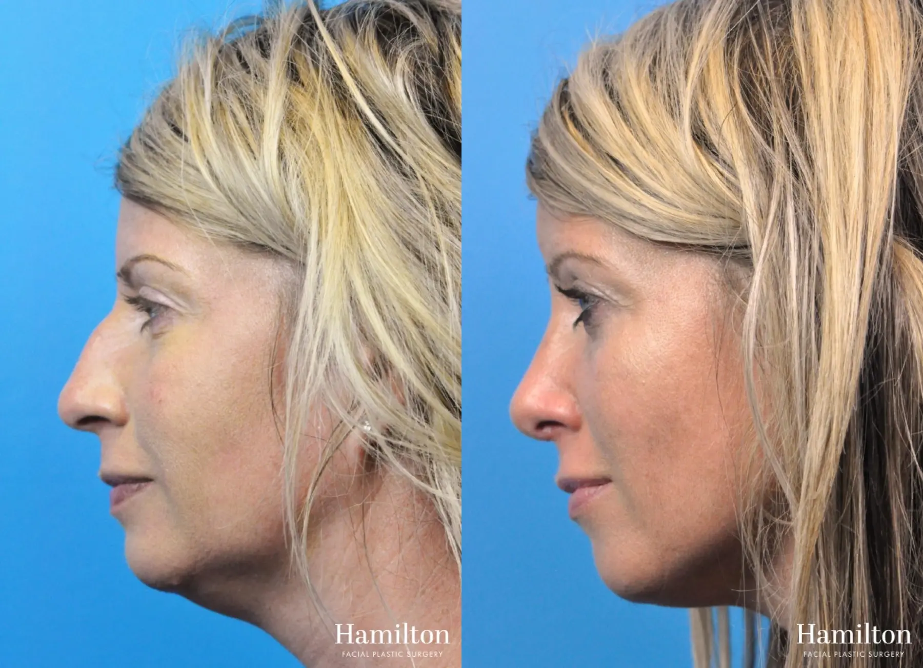 Rhinoplasty: Patient 32 - Before and After 1