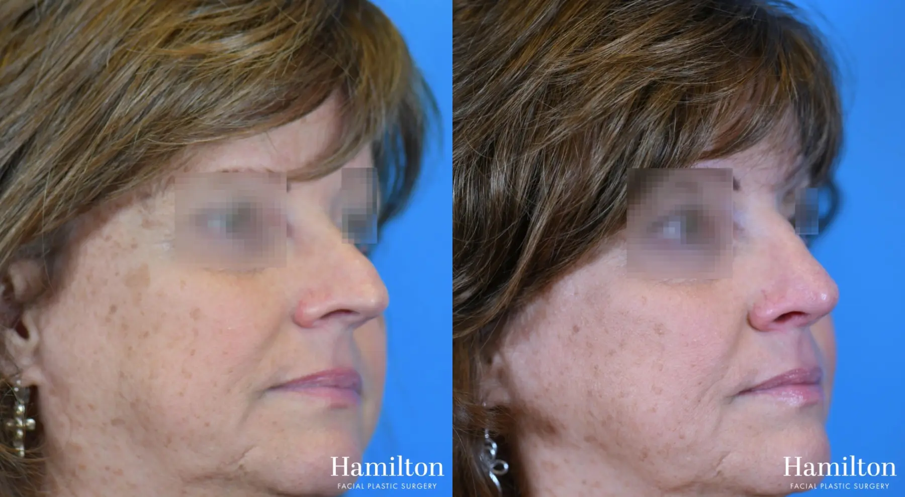 Rhinoplasty: Patient 40 - Before and After 3