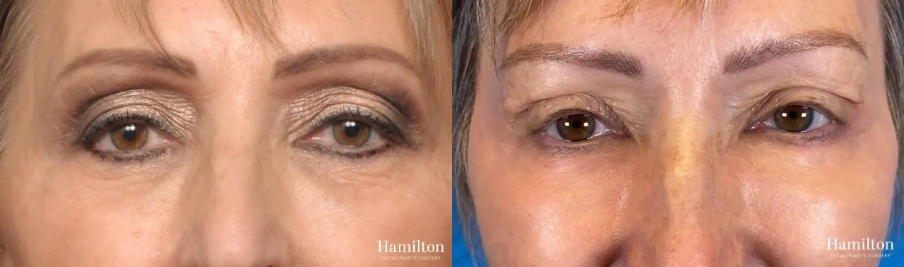 Sciton Laser: Patient 6 - Before and After  