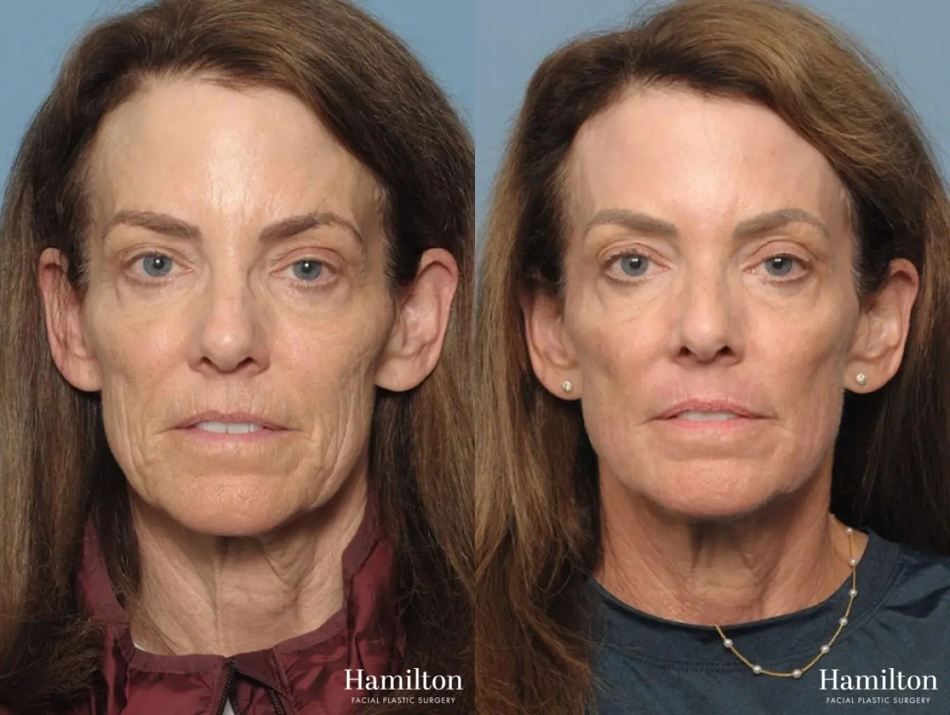 Sciton Laser: Patient 1 - Before and After  