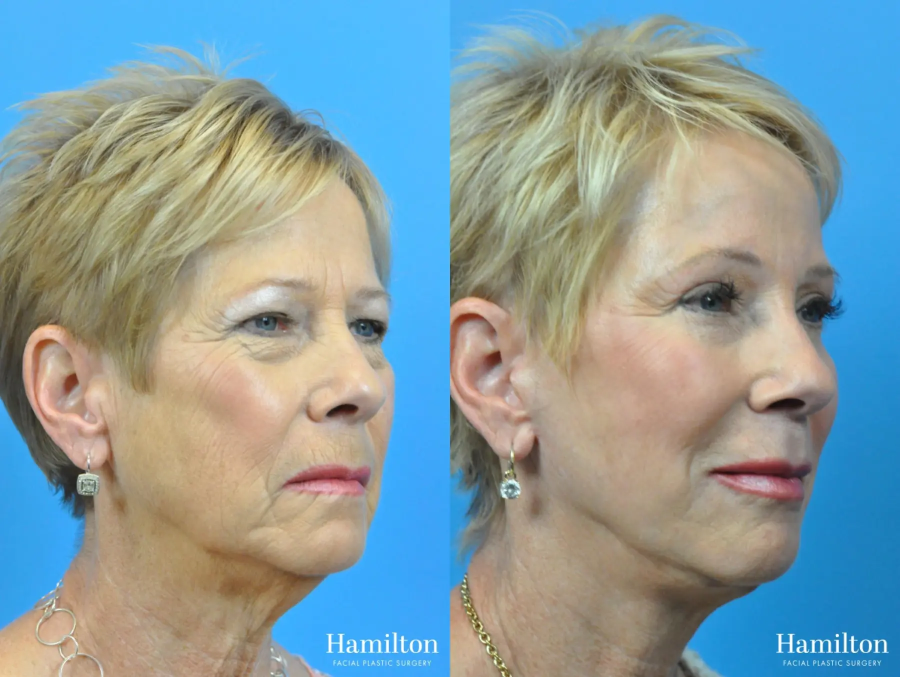 Sciton Laser: Patient 3 - Before and After 2