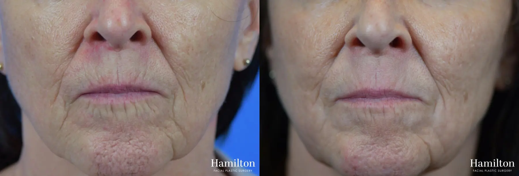 Sciton Laser: Patient 7 - Before and After  