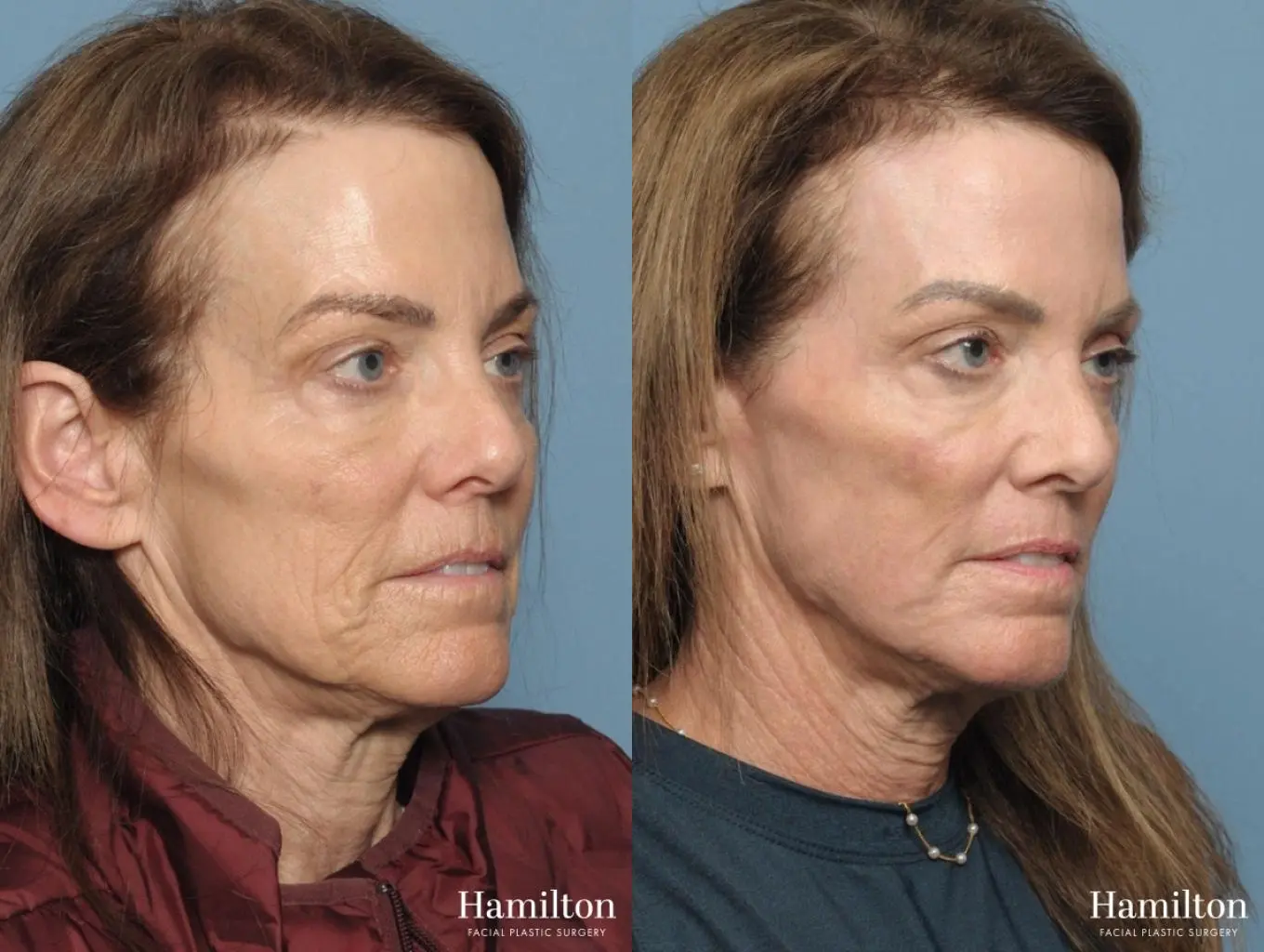 Sciton Laser: Patient 1 - Before and After 4