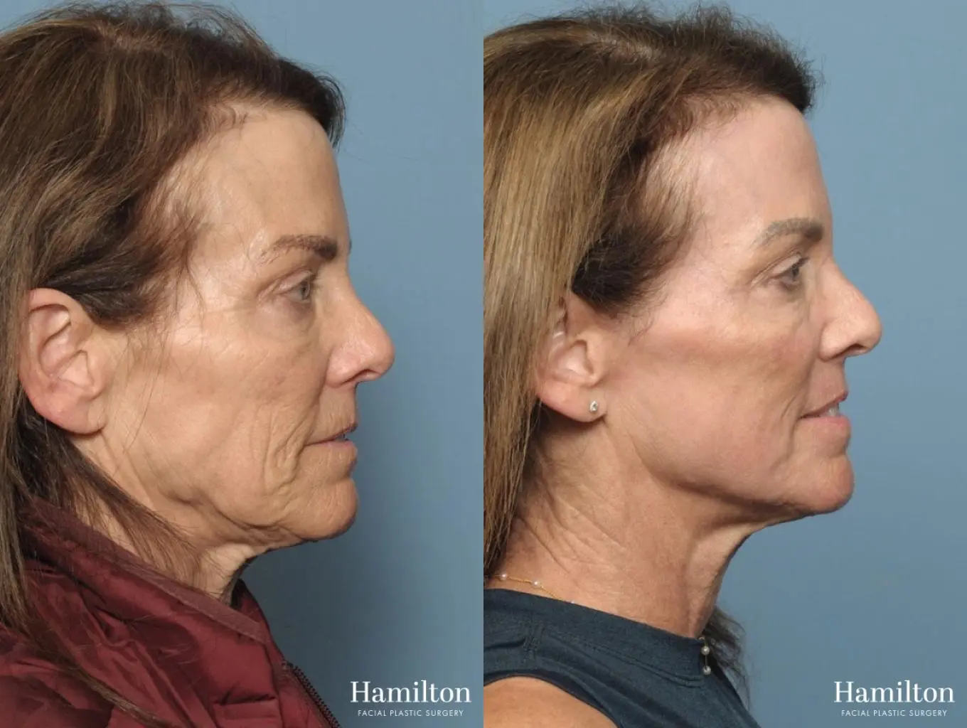 Sciton Laser: Patient 1 - Before and After 5