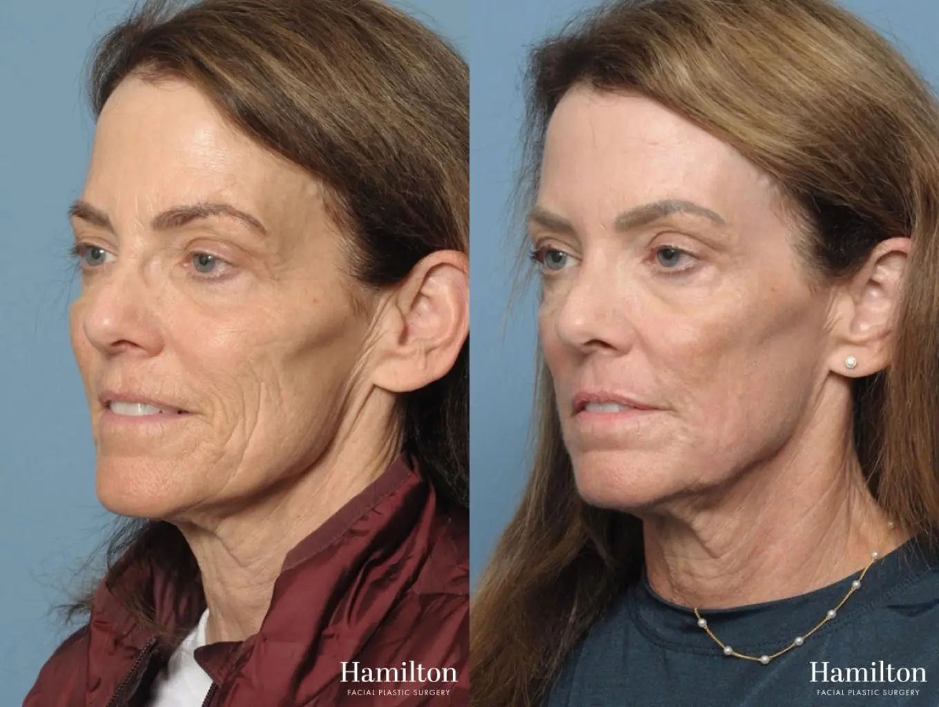 Sciton Laser: Patient 1 - Before and After 2