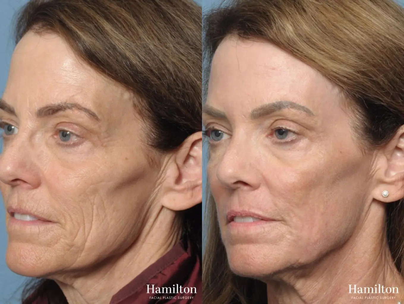 Sciton Laser: Patient 1 - Before and After 3