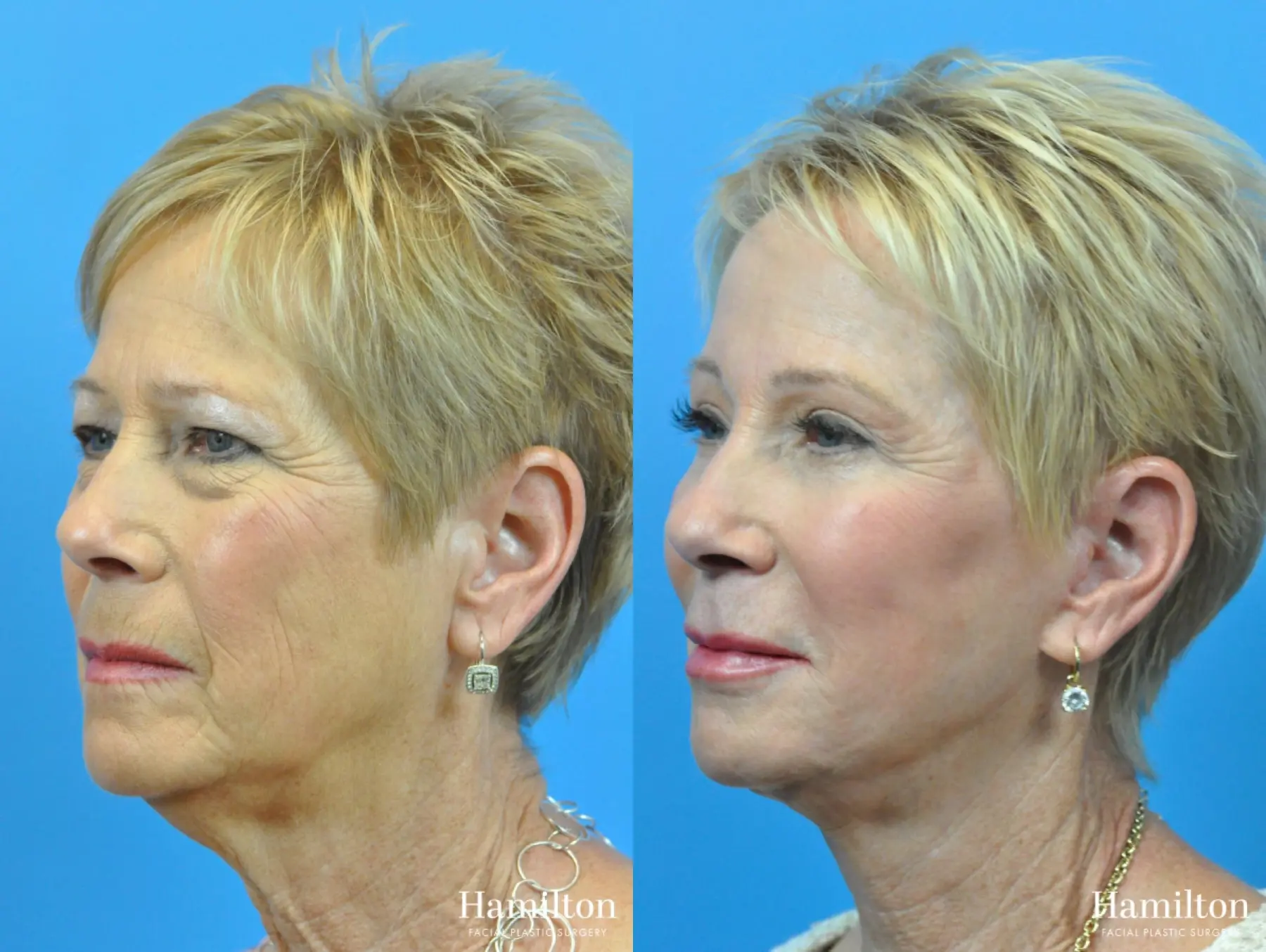 Sciton Laser: Patient 3 - Before and After  