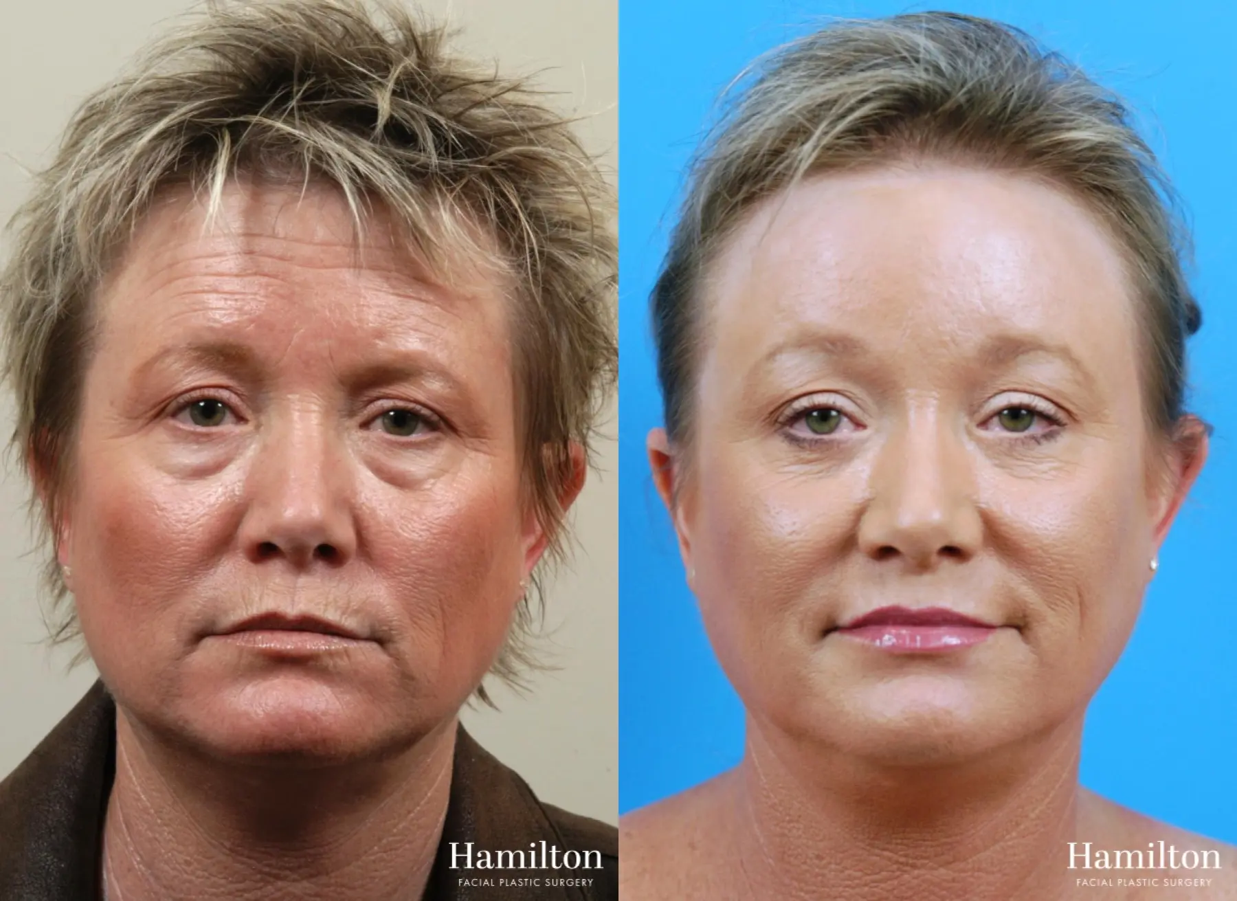 Sciton Laser: Patient 4 - Before and After  