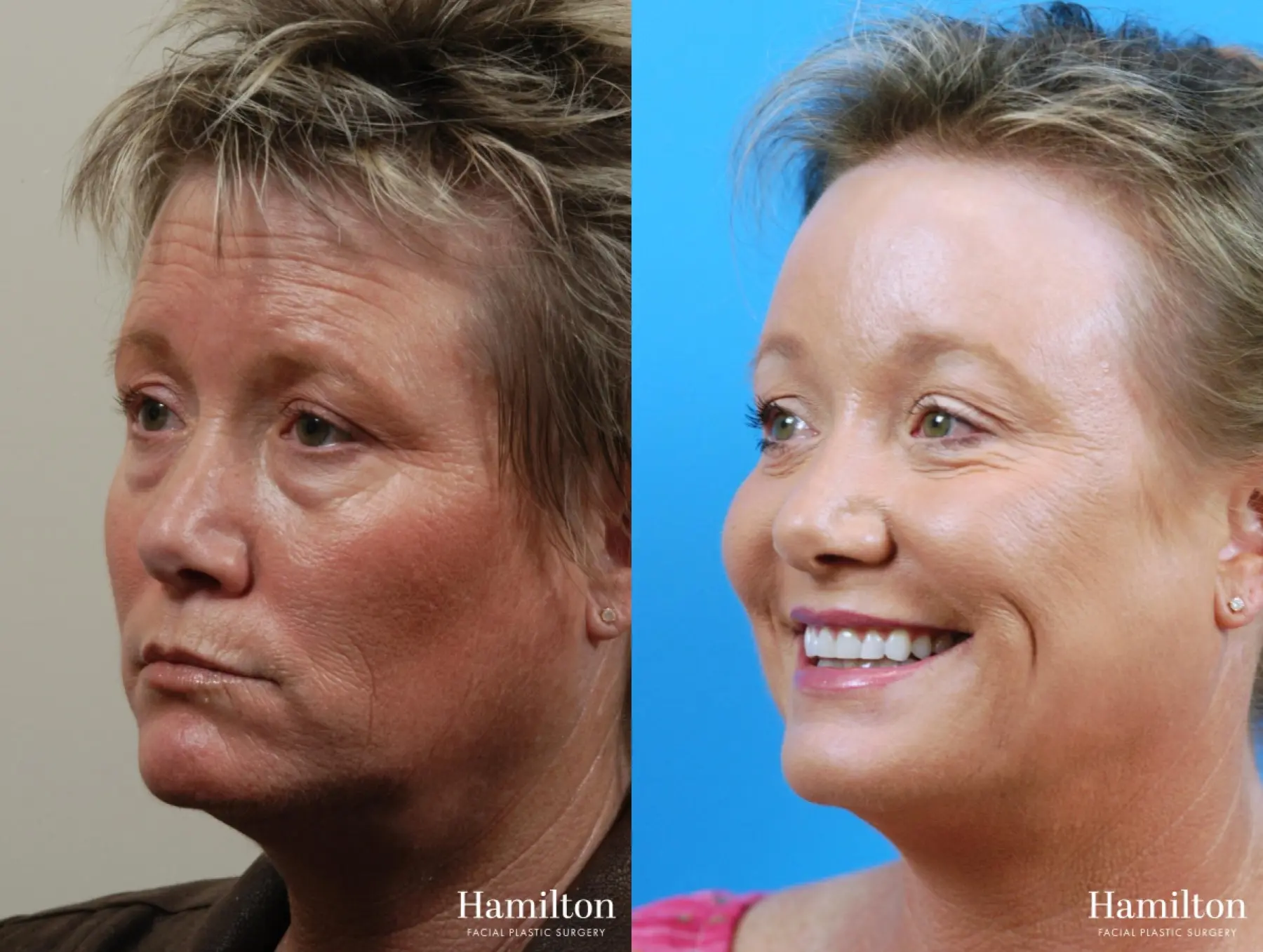 Sciton Laser: Patient 4 - Before and After 2