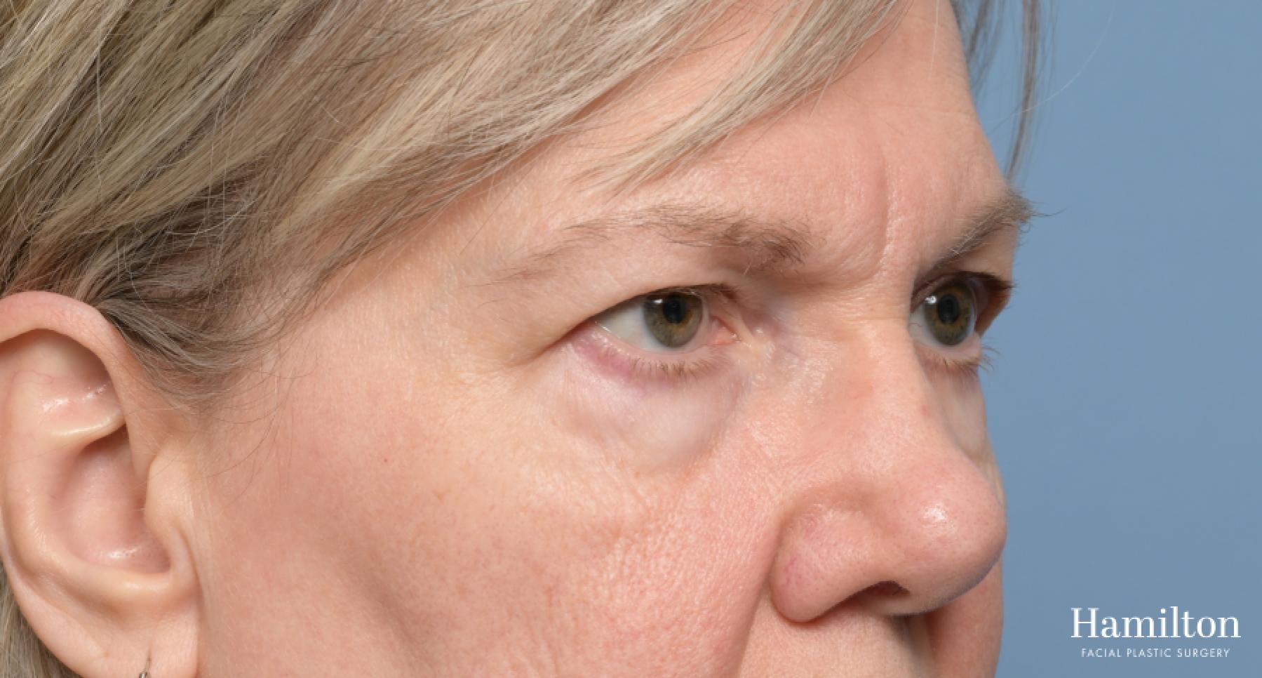 Blepharoplasty: Patient 18 - Before 4