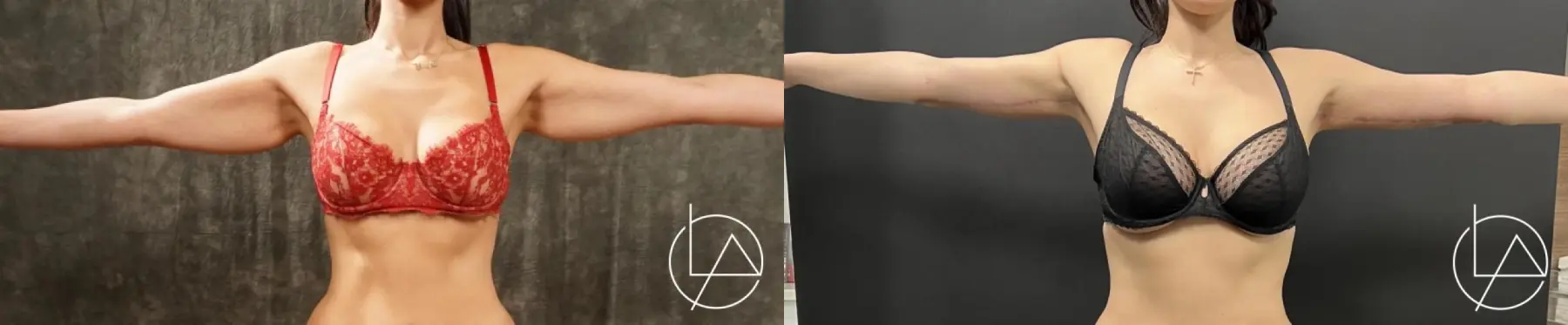 Arm Lift: Patient 2 - Before and After  