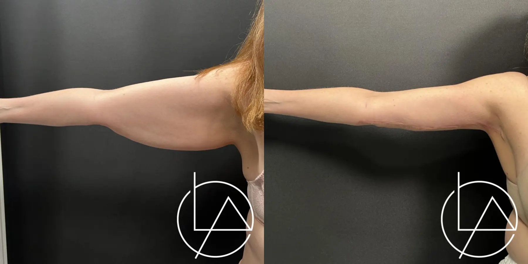 Arm Lift: Patient 1 - Before and After  