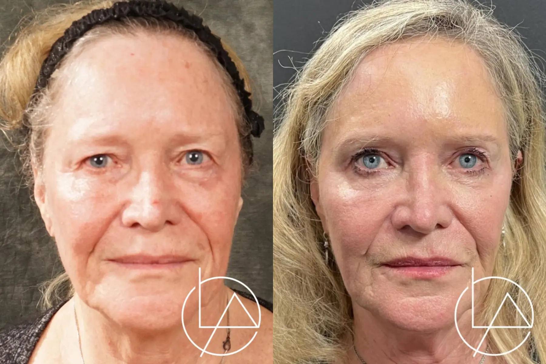 Blepharoplasty: Patient 1 - Before and After  