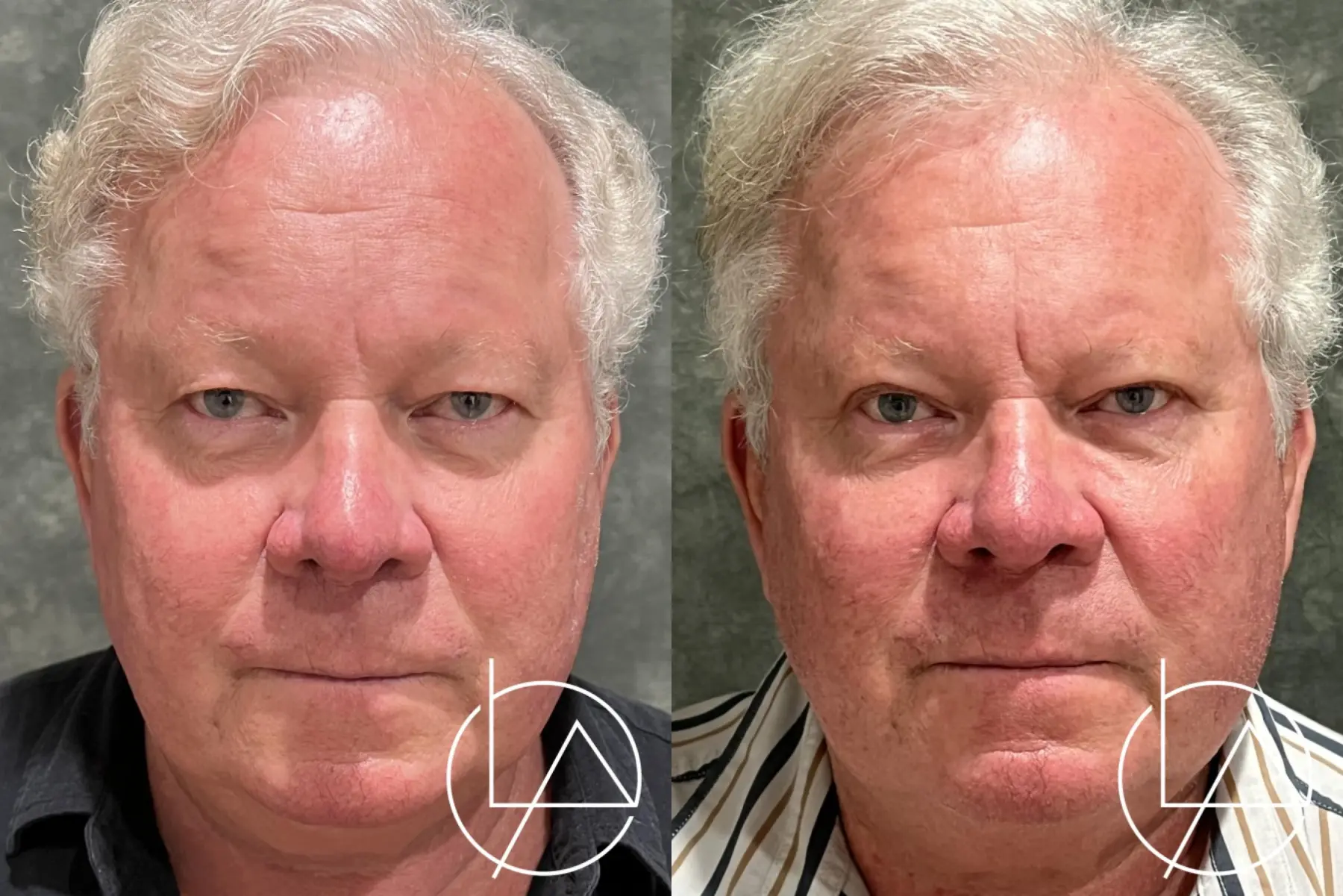 Blepharoplasty-for-men: Patient 1 - Before and After  