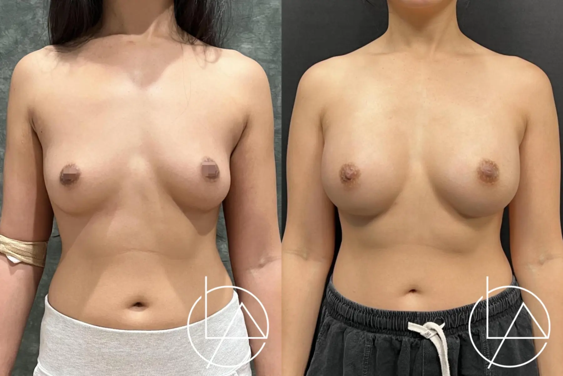 Breast Augmentation: Patient 2 - Before and After  