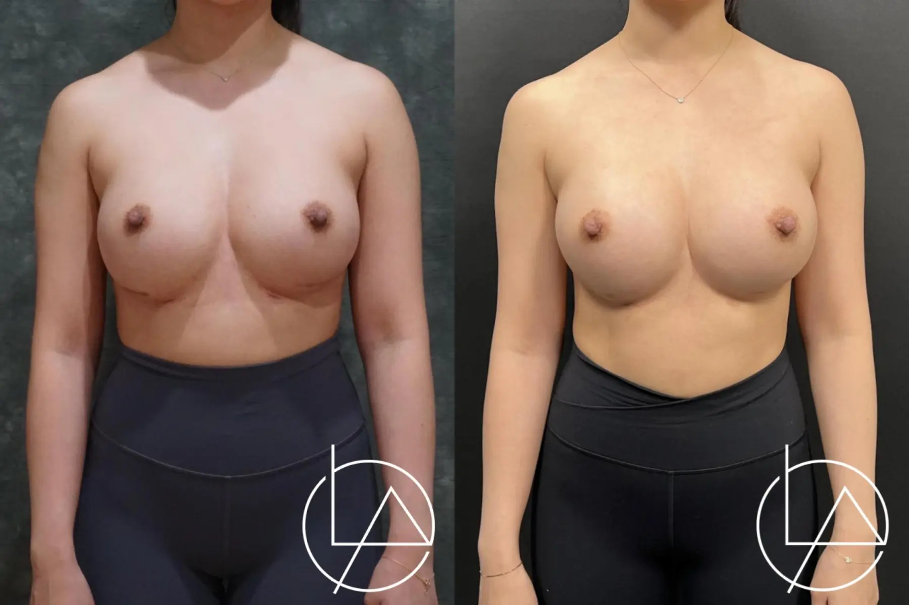 Breast Implant Exchange: Patient 2 - Before and After  