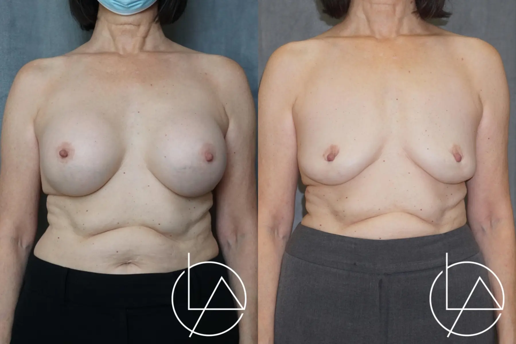 Breast Implant Removal: Patient 1 - Before and After  