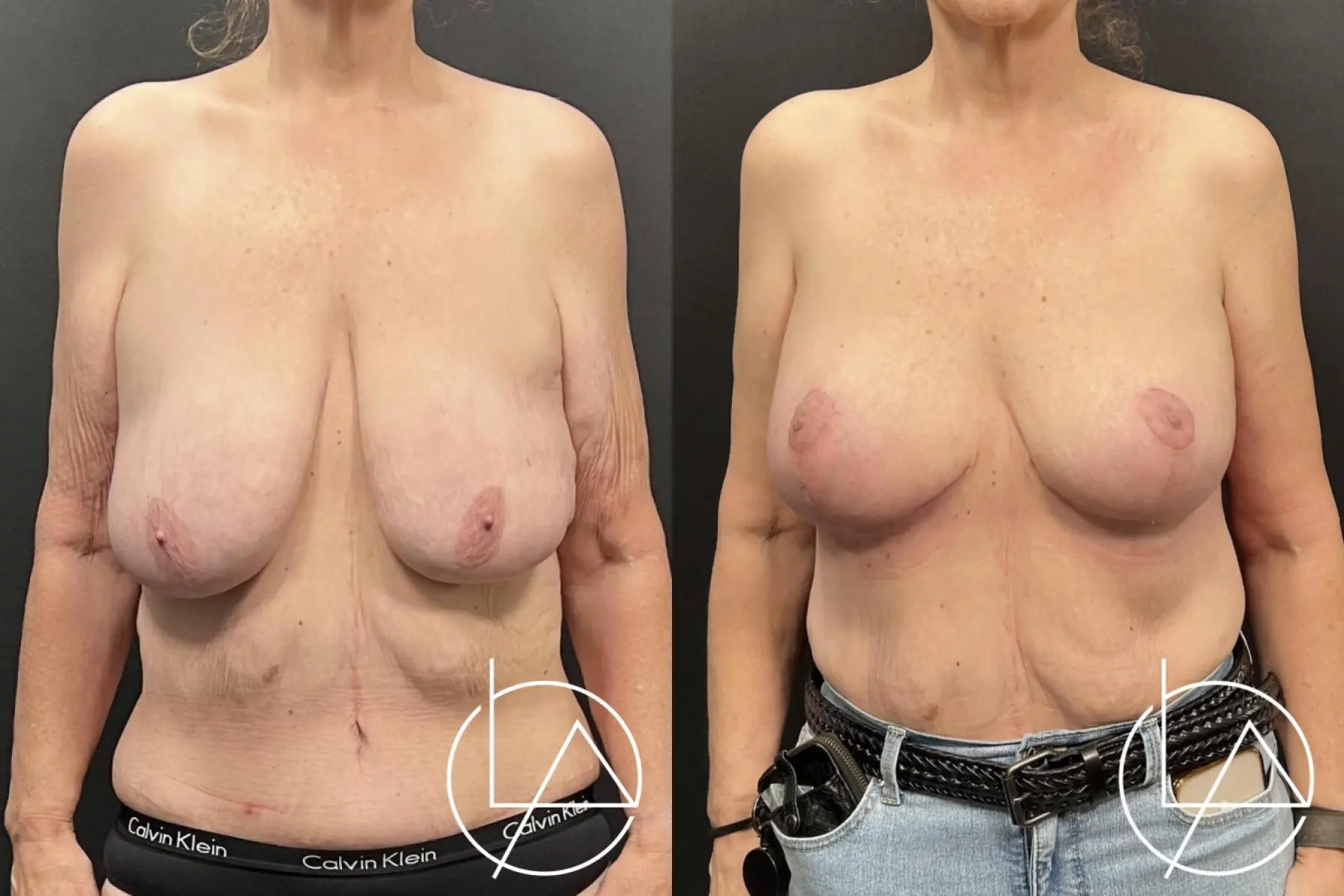 Breast Lift: Patient 1 - Before and After  