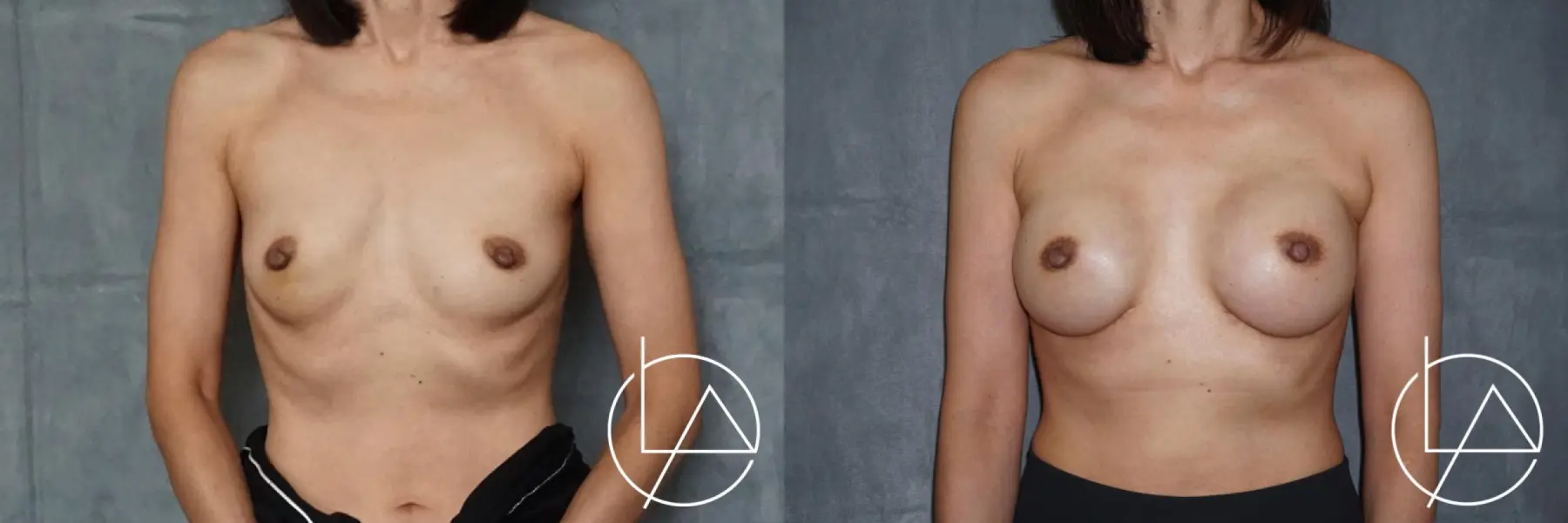 Breast Reconstruction: Patient 1 - Before and After  