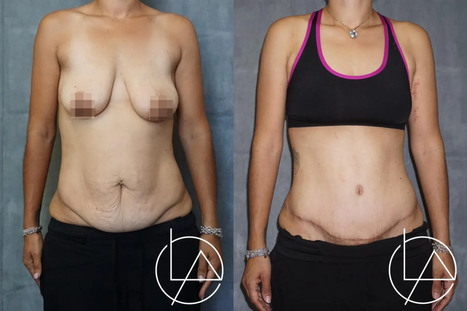 Drainless Tummy Tuck: Patient 1 - Before and After  