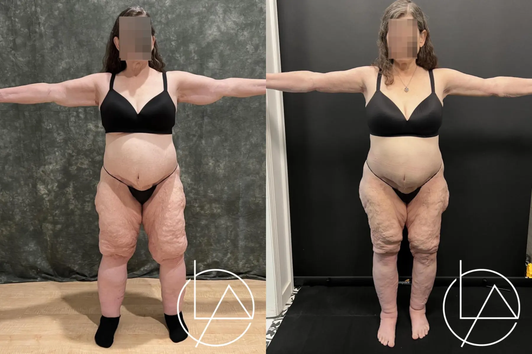 Lipedema Surgery: Patient 5 - Before and After  