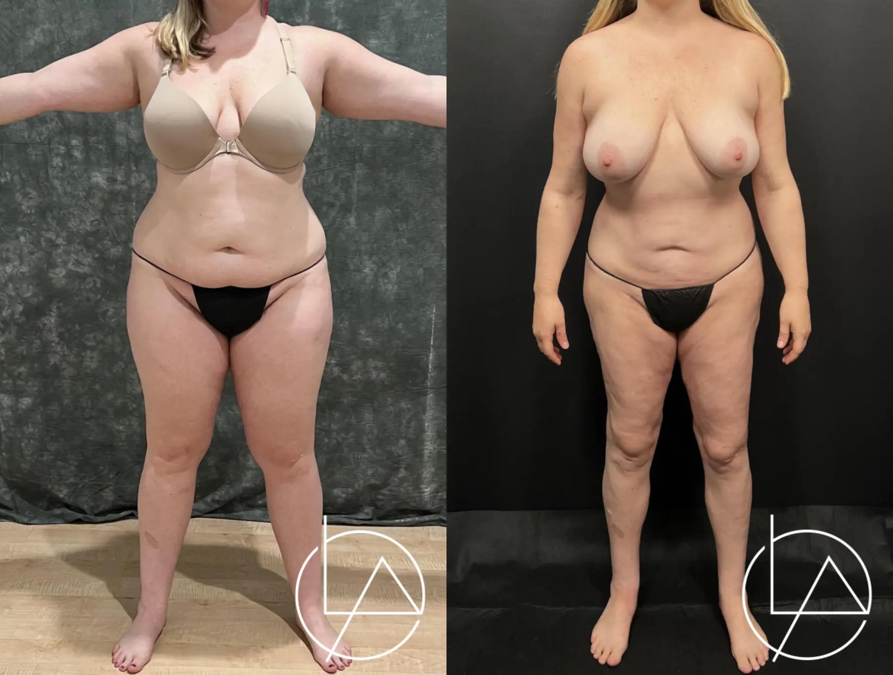 Lipedema Surgery: Patient 6 - Before and After  