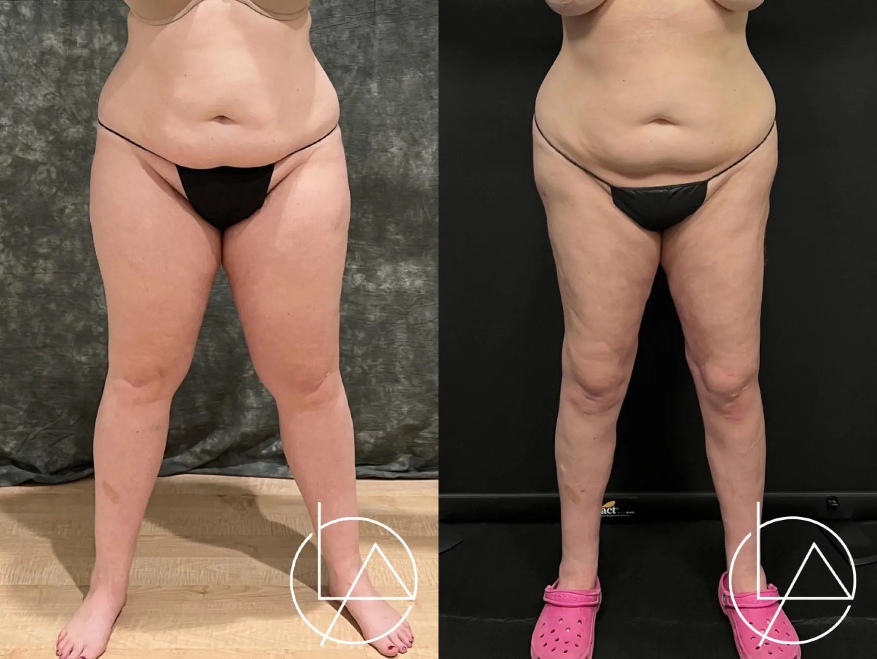 Lipedema Surgery: Patient 4 - Before and After  