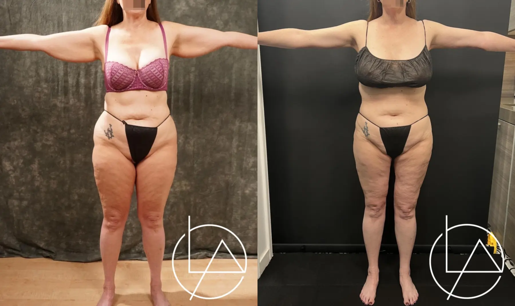 Lipedema Surgery: Patient 4 - Before and After  