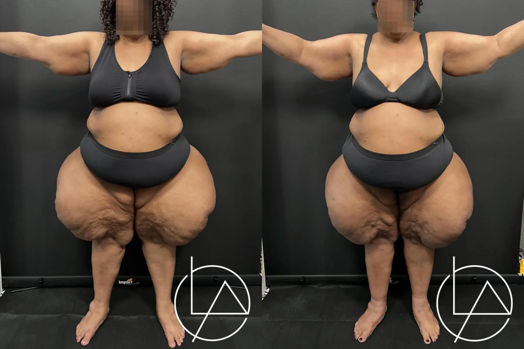 Lipedema Surgery: Patient 2 - Before and After  