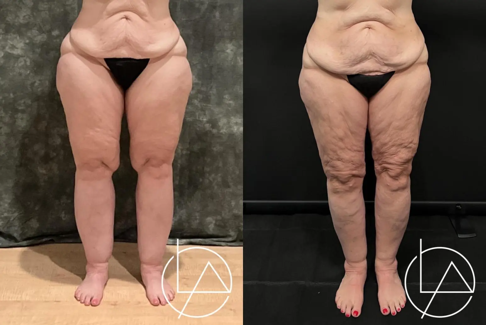 Lipedema Surgery: Patient 5 - Before and After  