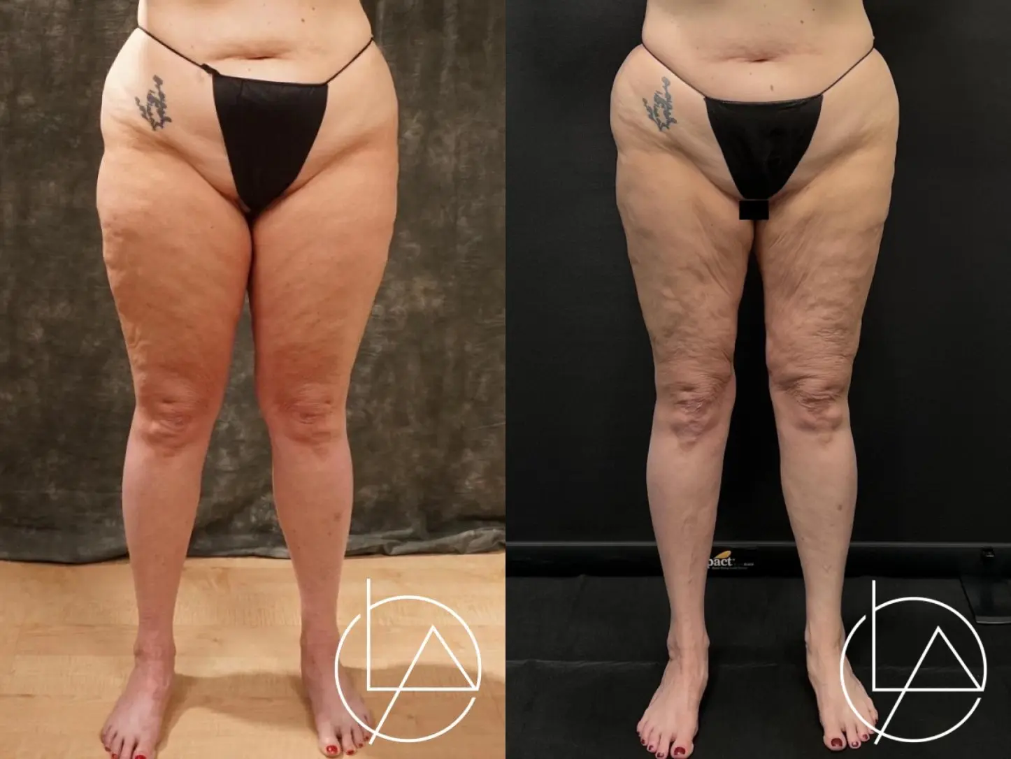 Lipedema Surgery: Patient 3 - Before and After  