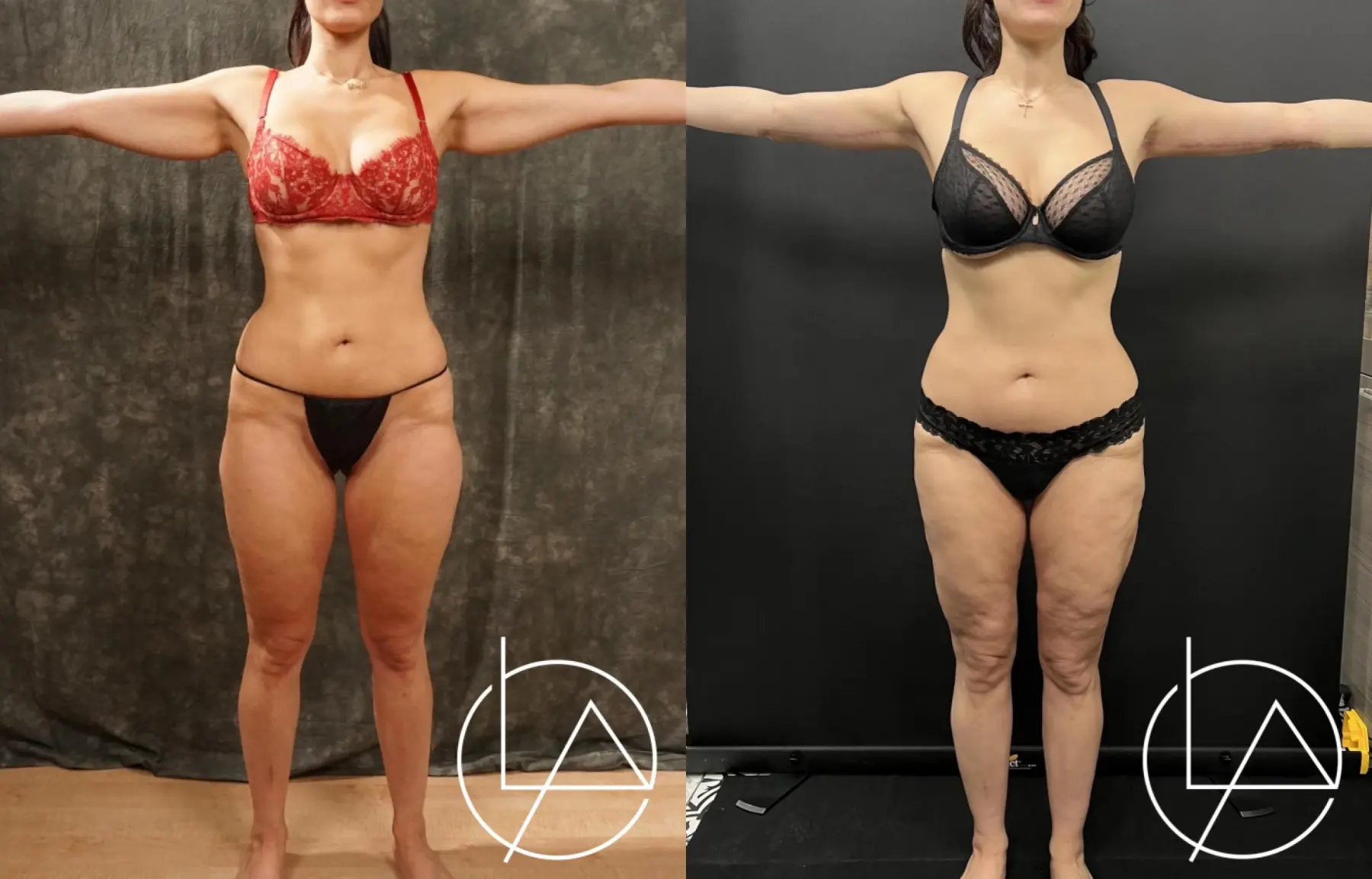 Lipedema Surgery: Patient 2 - Before and After  