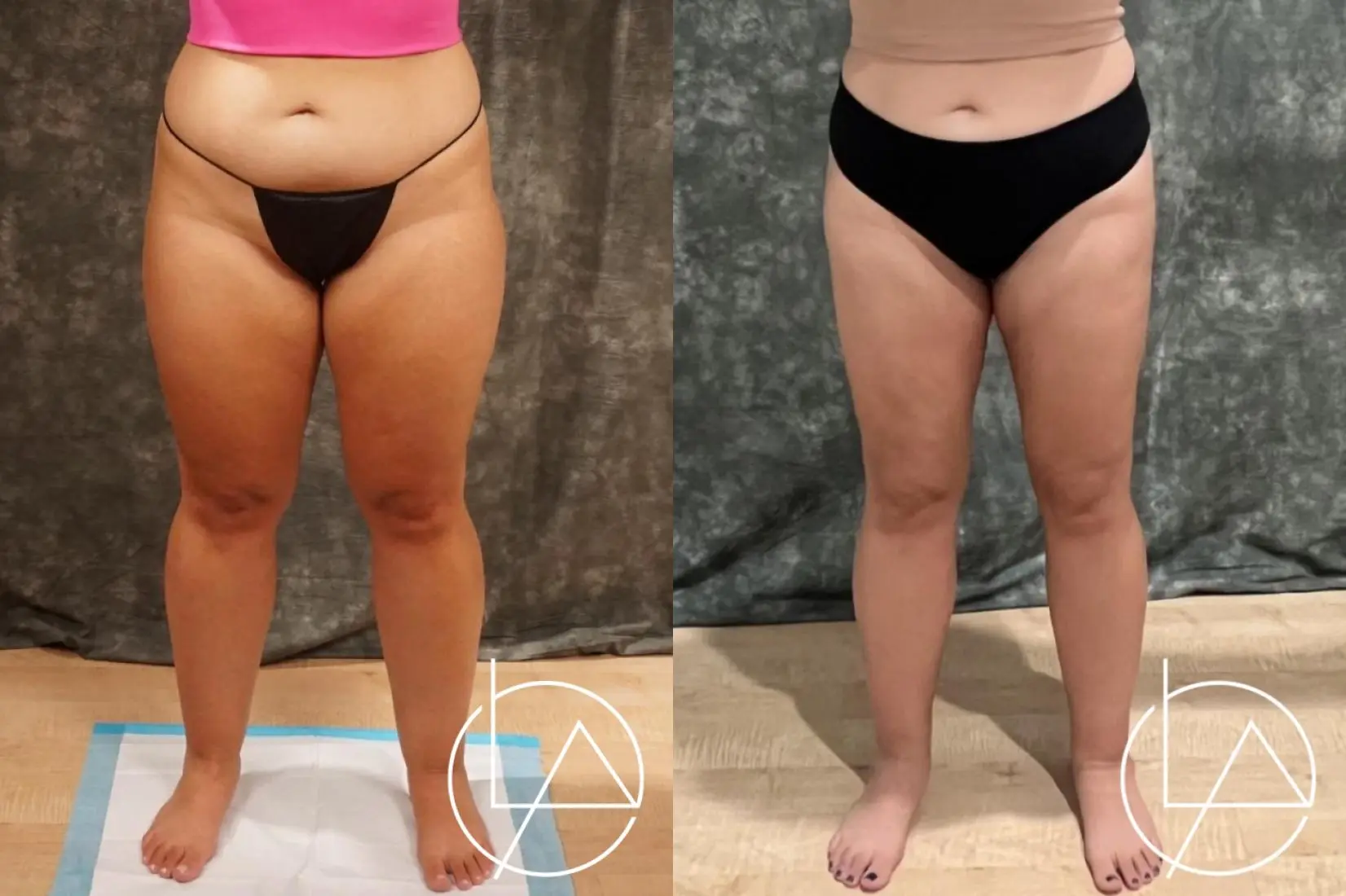 Lipedema Surgery: Patient 1 - Before and After  