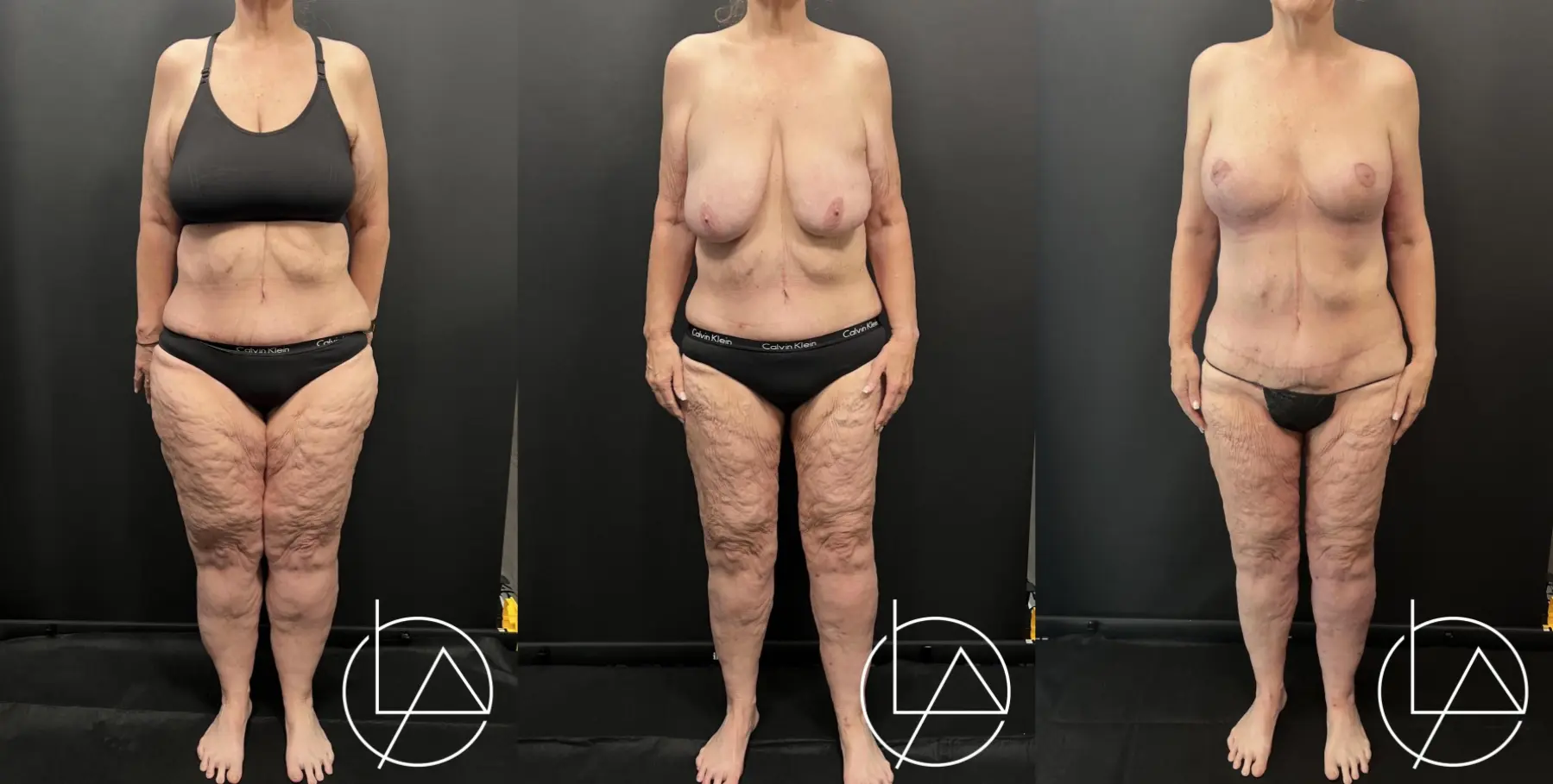 Lipedema Surgery: Patient 7 - Before and After  