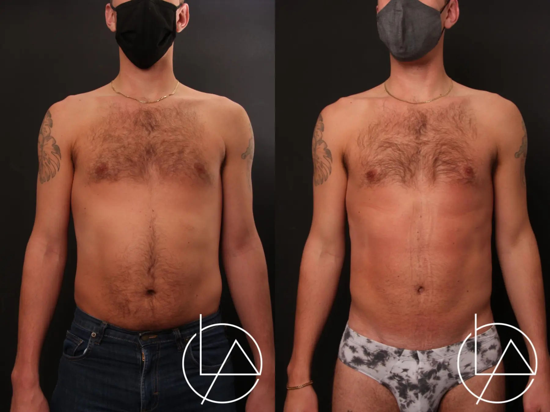 Liposuction-for-men: Patient 1 - Before and After  