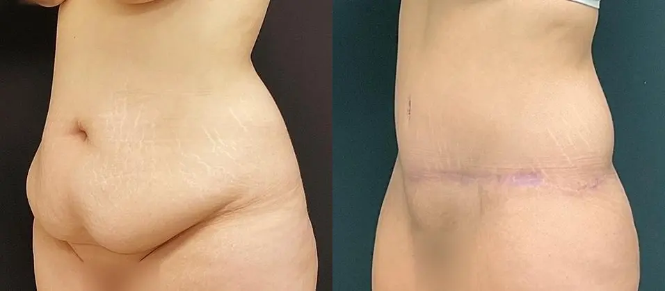 Tummy Tuck: Patient 2 - Before and After 2