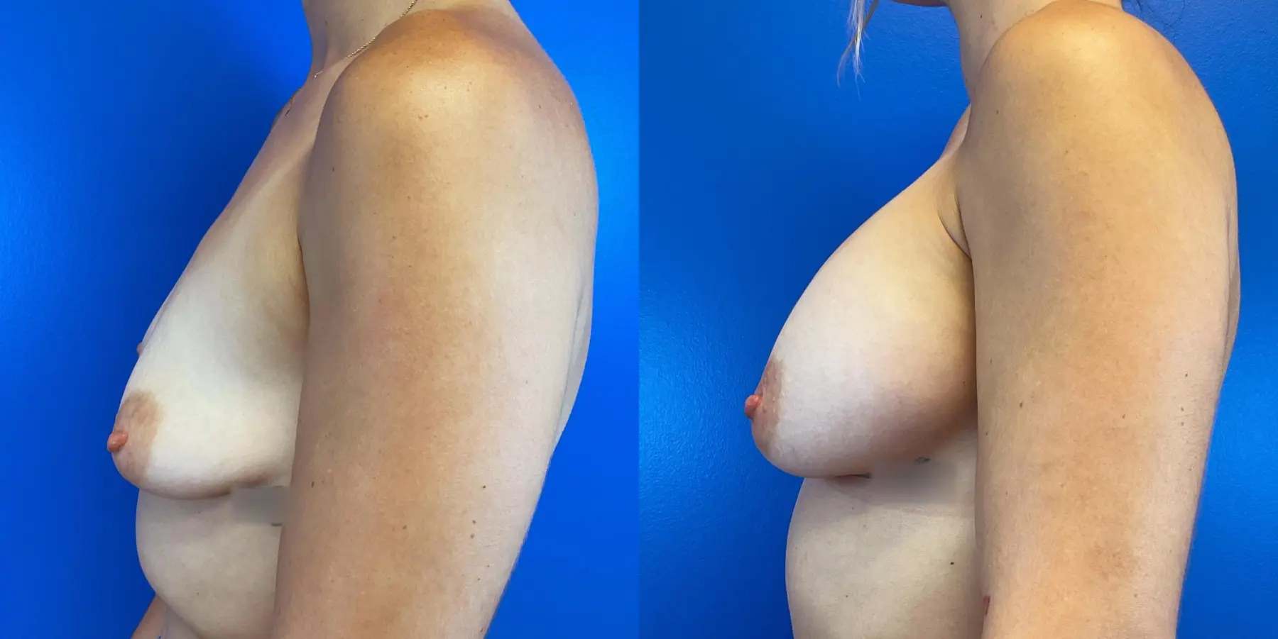 Breast Augmentation: Patient 1 - Before and After 4