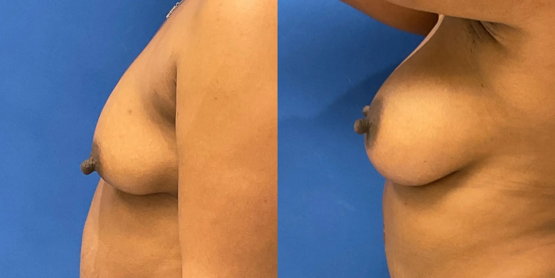 Breast Augmentation: Patient 15 - Before and After 4