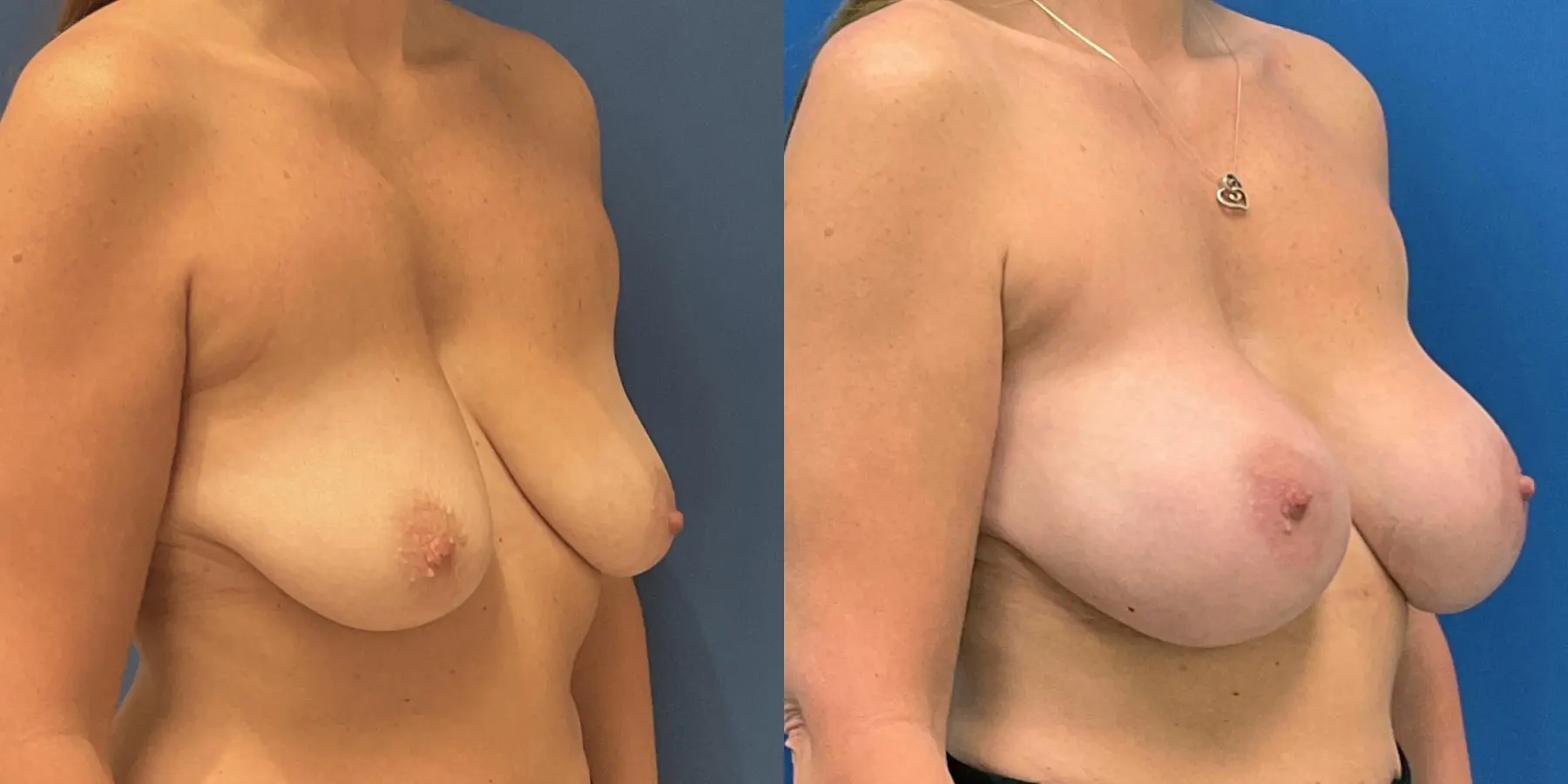 Breast Augmentation: Patient 10 - Before and After 3