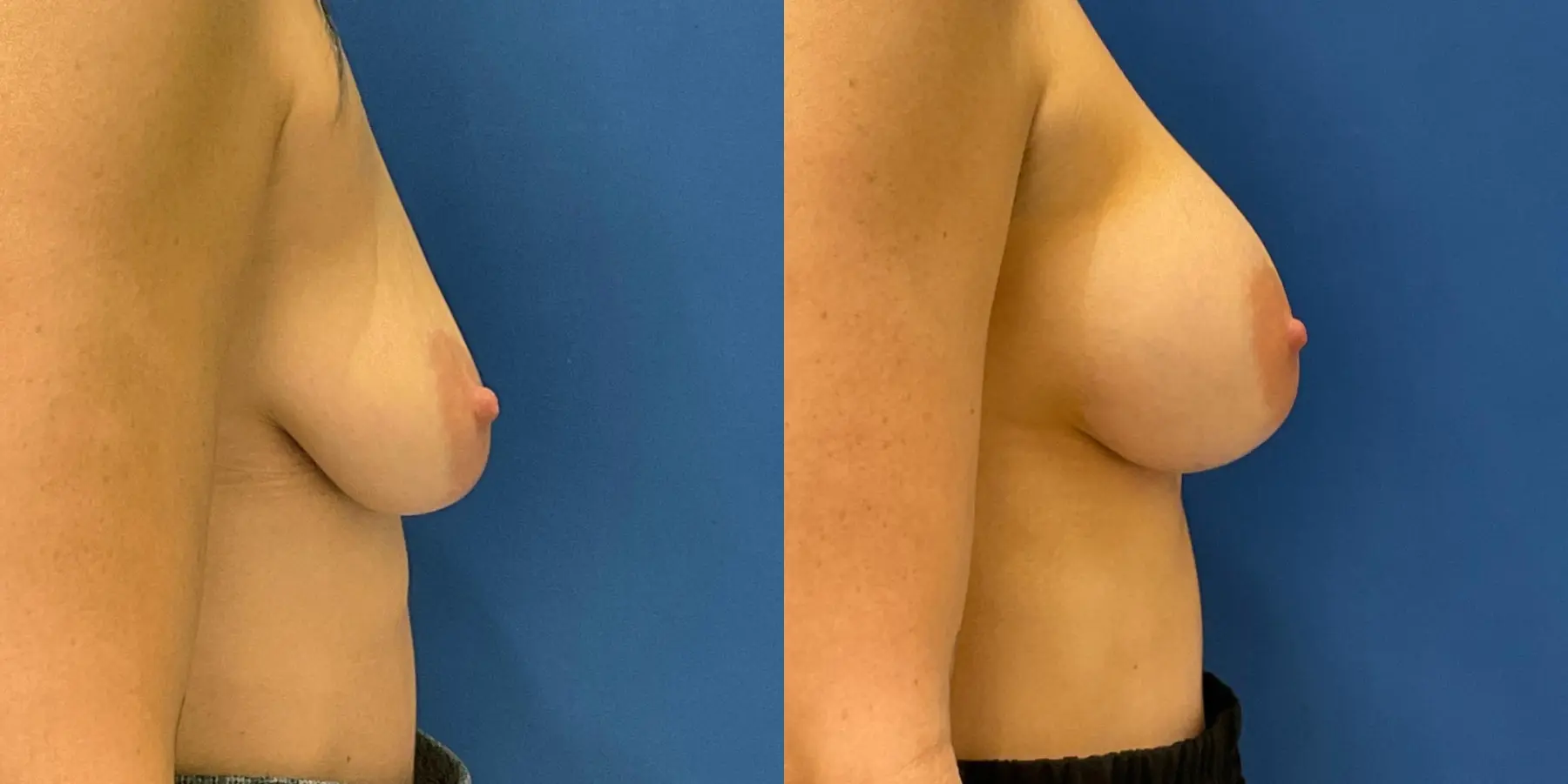 Breast Augmentation: Patient 14 - Before and After 5