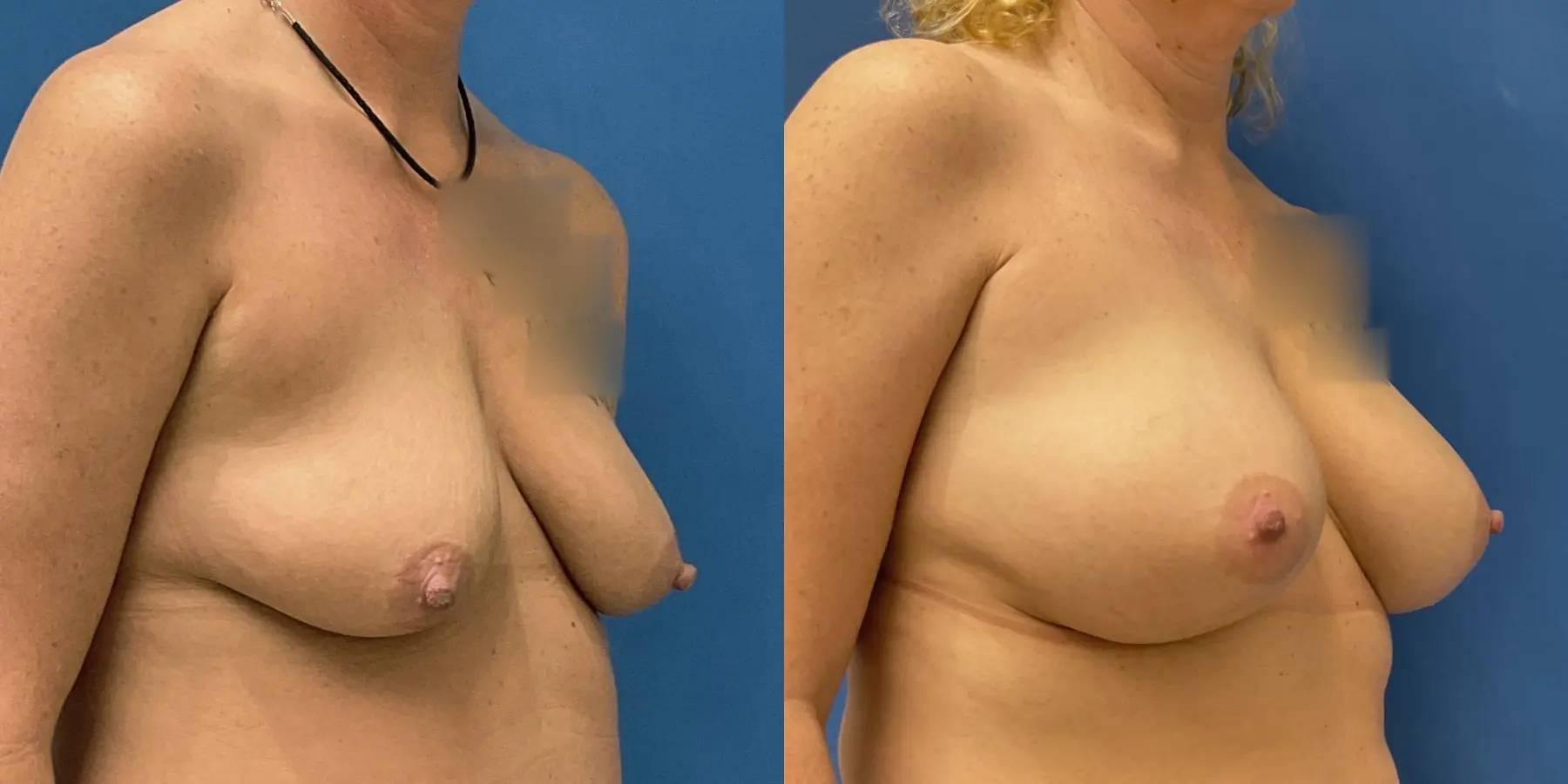 Breast Augmentation: Patient 5 - Before and After 3