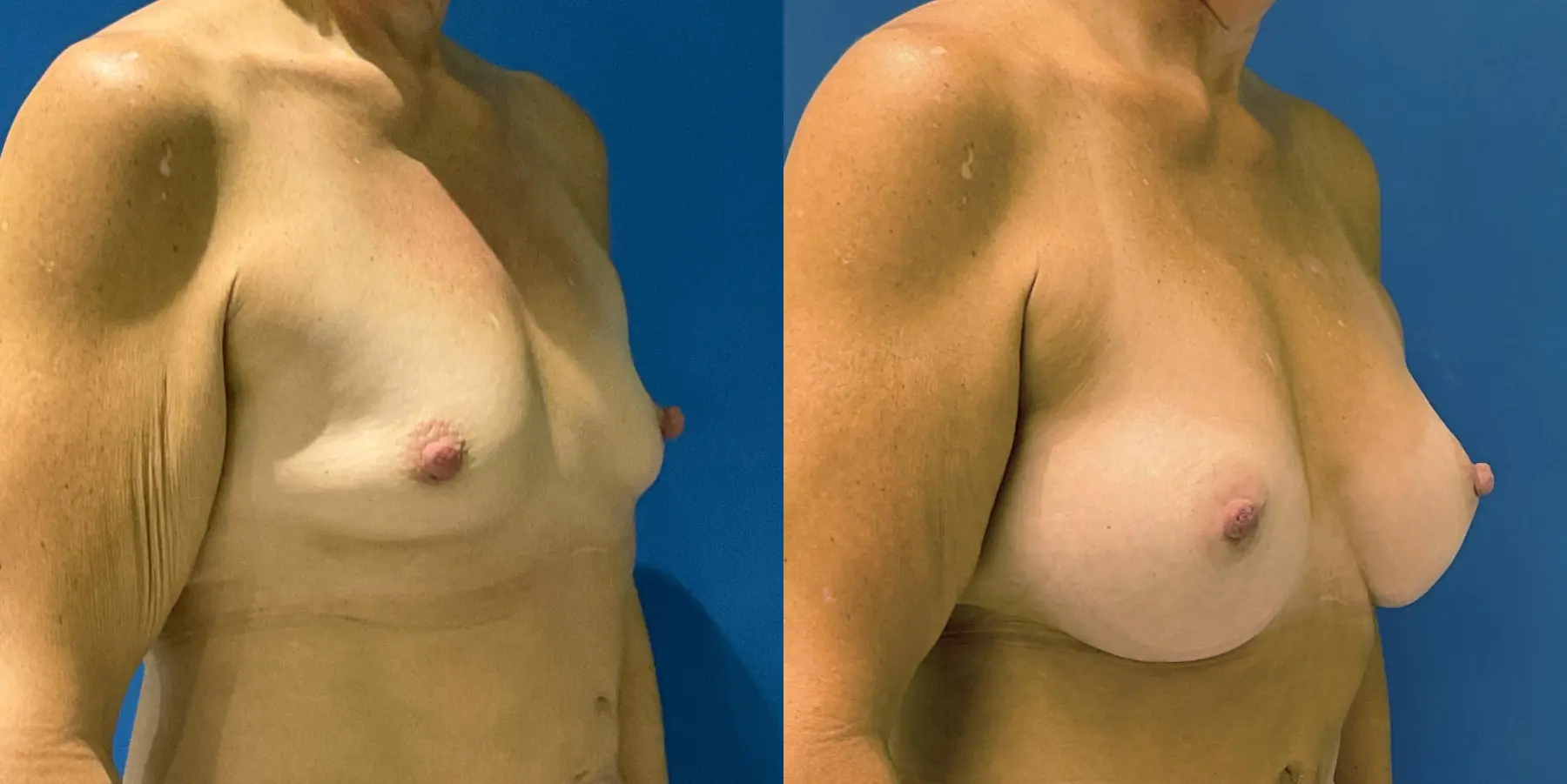 Breast Augmentation: Patient 6 - Before and After 3