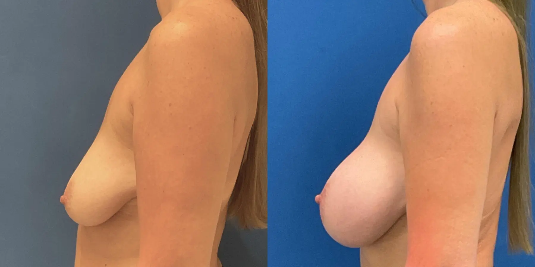 Breast Augmentation: Patient 10 - Before and After 4