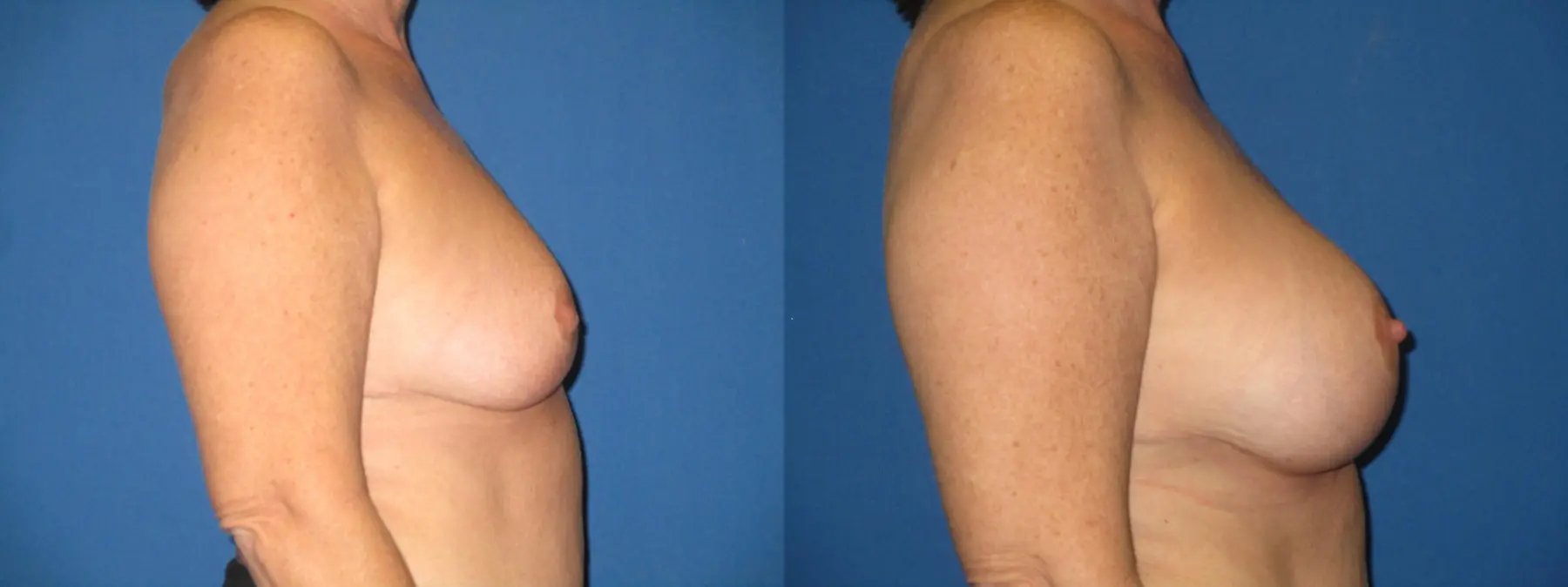 Breast Augmentation: Patient 22 - Before and After 3