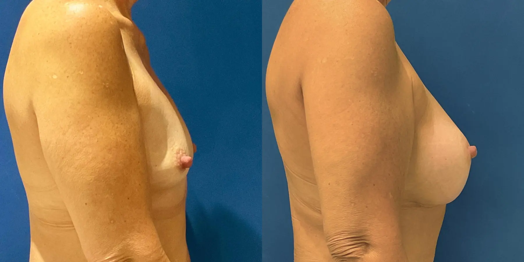 Breast Augmentation: Patient 6 - Before and After 5