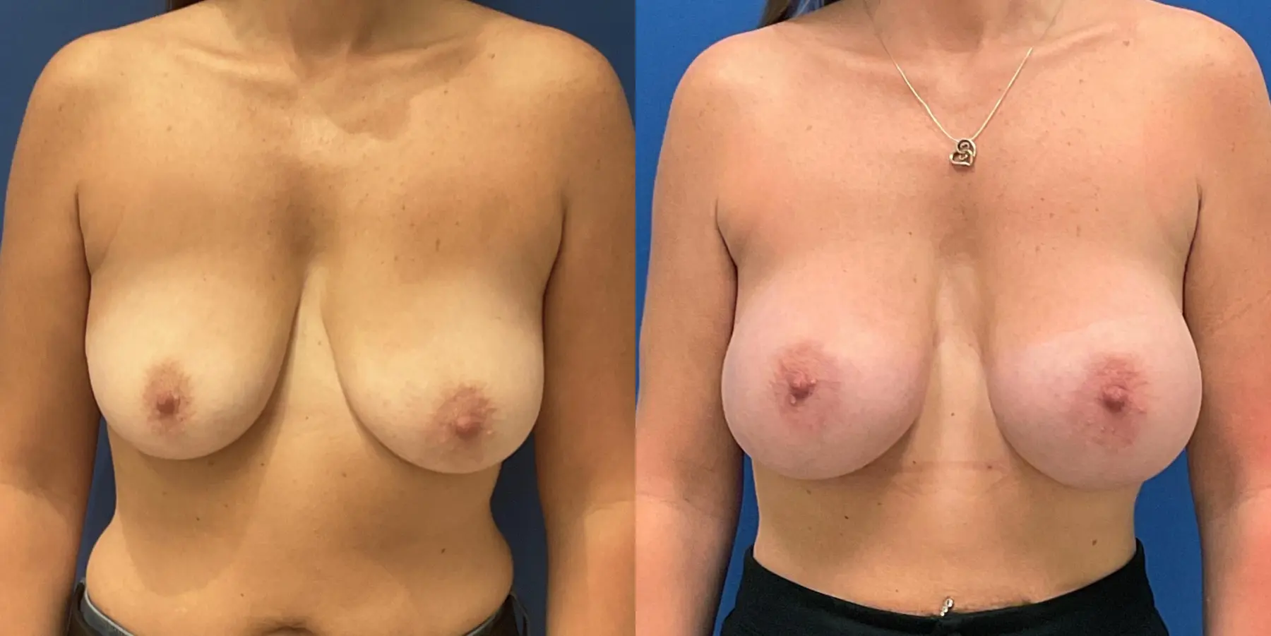 Breast Augmentation: Patient 10 - Before and After 1