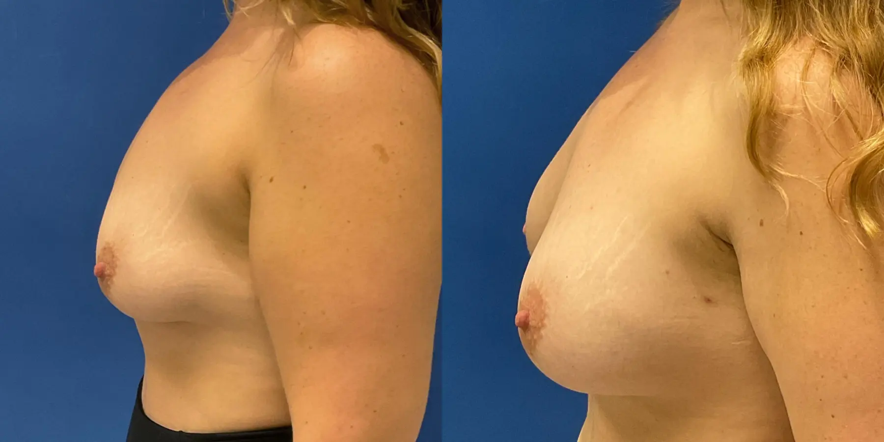 Breast Augmentation: Patient 19 - Before and After 4