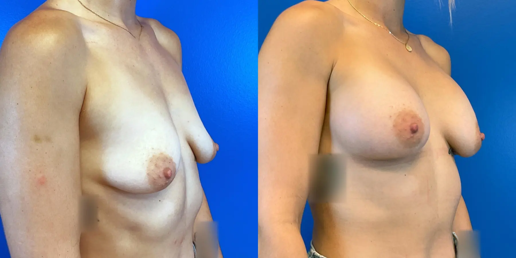 Breast Augmentation: Patient 1 - Before and After 3