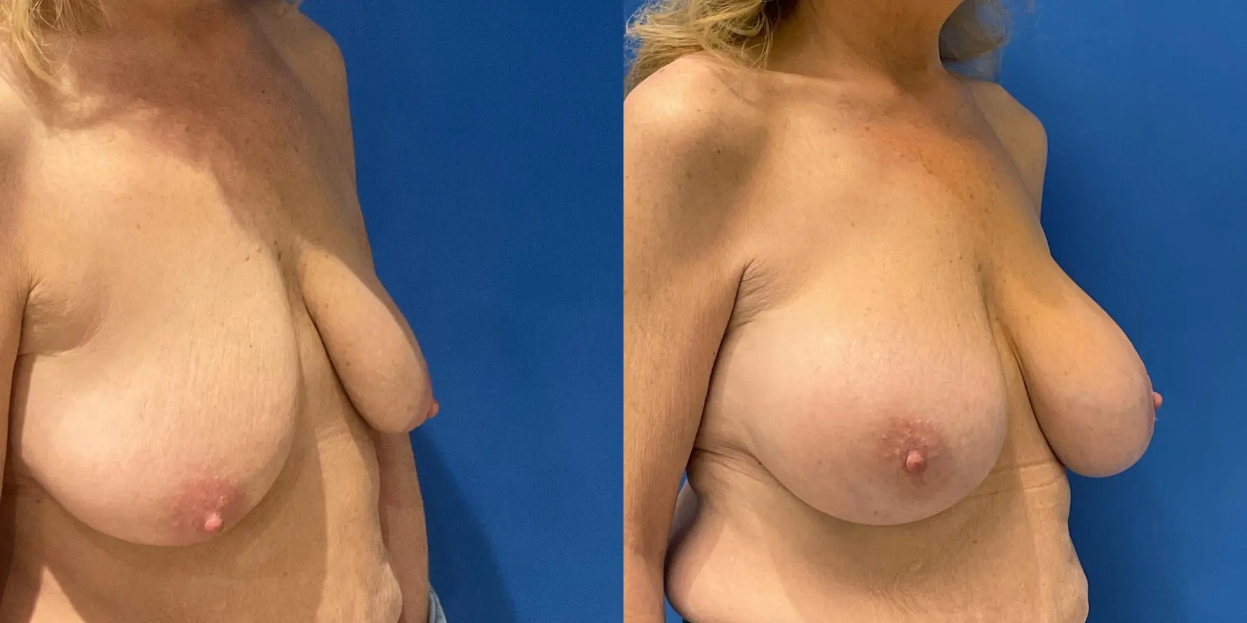 Breast Augmentation: Patient 9 - Before and After 3